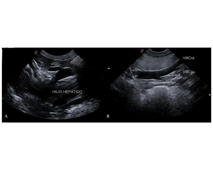 Figura 4. Anatomía ecográfica normal de la vena porta. (A) Región del hilio. Tronco principal y vena gastroduodenal (VGD) en caninos. (B) Porción media caudal del tronco principal de la vena porta. TGE: Tronco gastroesplénico. VMCra: vena mesentérica craneal, VMCau: vena mesentérica caudal.