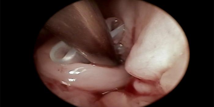 FIGURA 3A-B. Colocación de un stent de silicona en un cachorro con edema de glotis traumático.