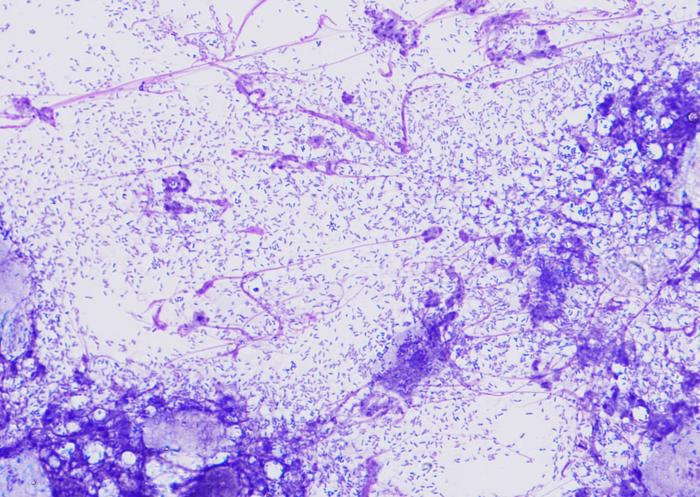 Figura 5. Citología auricular de un paciente con otitis crónica supurativa por Pseudomonas. Obsérvese la gran cantidad de neutrófilos degenerados y de bacterias bacilares.