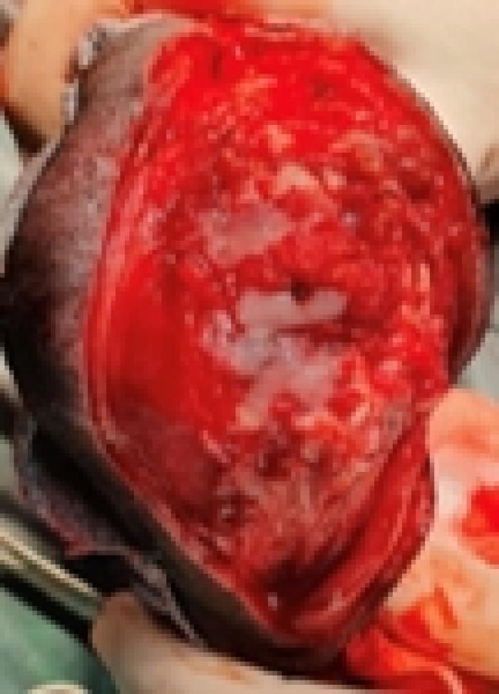 Figura 12. Imagen quirúrgica. Carpo en flexión tras fresado y colocación de hueso esponjoso y factores de crecimiento.