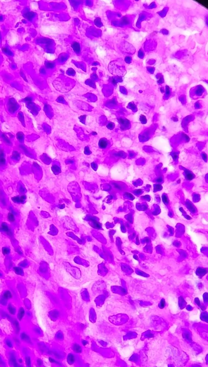 Figura 7. Macrófagos epitelioides y linfocitos mezclados con un número moderado de células plasmáticas y ocasionalmente neutrófilos y células gigantes multinucleadas, el epitelio mucoso suprayacente presentó espongiosis y exocitosis de leucocitos y evidenció la presencia de múltiples formas de amastigotes de Leishmania spp.