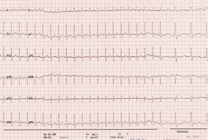 Figura 1. Electrocardiograma de 6 derivaciones obtenido en decúbito lateral derecho el día de la primera visita, mostrando una taquiarritmia supraventricular sostenida a 300 lat/min de frecuencia ventricular instantánea donde no se pueden identificar las ondas P. 50 mm/s; 0.5 cm = 1 mV; en la parte de la derecha se puede observar un trazado a 100 mm/s y 0.5 mm = 1 mV.