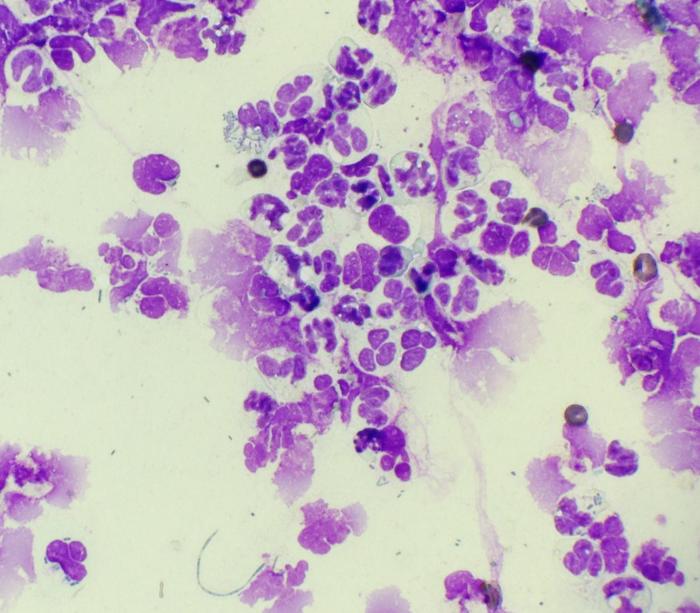 Figura 19. La imagen muestra una marcada respuesta inflamatoria neutrofílica. Se observan microorganismos tanto en el fondo de la preparación como intracitoplasmáticos.