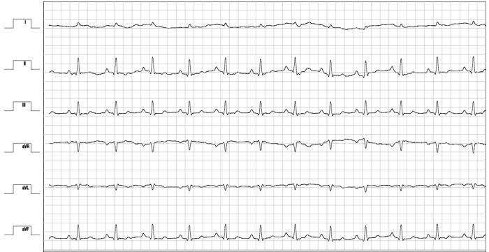 Figura 4. Electrocardiograma de superficie 6 derivaciones del paciente de la Figura 1 tras la ablación de una vía accesoria posterior y lateral. Ritmo sinusal sin anomalías de la conducción.
