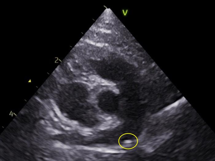 Figura 8. Imagen ecocardiográfica de un gato parasitado por Dirofilaria immitis. Vista paraesternal derecha. Corte transversal o de eje corto a nivel de la bifurcación de las arterias pulmonares, donde se observan líneas hiperecoicas paralelas compatibles con vermes adultos (círculo amarillo).