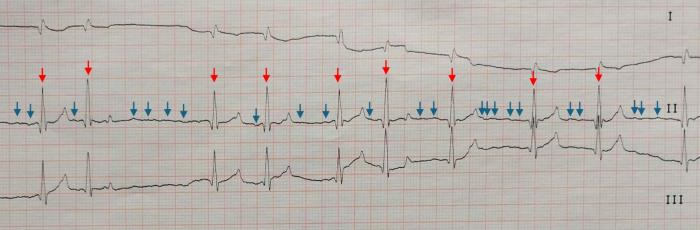 Figura 1. Electrocardiograma con presencia de fibrilación atrial en tres derivaciones a 50 mm/s y 10 mm/mV perteneciente a un perro Mastín macho de 7 años. Se observa la presencia de ondas f atriales (flechas azules) y un ritmo ventricular irregularmente irregular (flechas rojas).