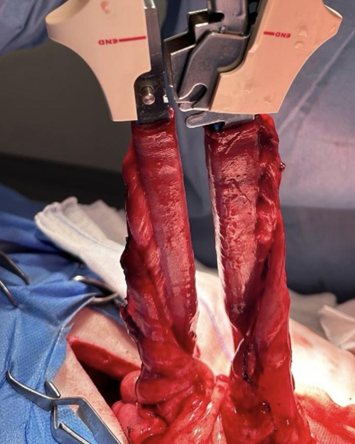 Figura 2. Imagen intraquirúrgica. Grapadora GIA colocada en los extremos intestinales por el borde antimesentérico.