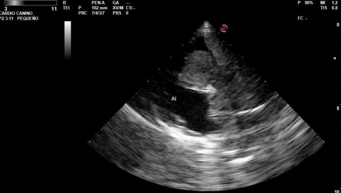 Figura 6. (A) En el ecocardiograma se observa una masa que abarca la base cardíaca y el atrio derecho. (B) En el ecocardiograma se observa una masa rodeando la arteria pulmonar y sus ramas. (C) Mediciones ecocardiograma (imágenes cortesía del Dr. C. Daniel Rodríguez M.N. 9492).