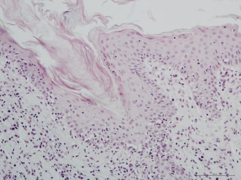 Examen dermatopatológico a partir de biopsias cutáneas, región dermo-epidérmica: el infiltrado inflamatorio es linfocítico con infiltrado de estas células a la epidermis (exocitosis). Numerosos queratinocitos aparecen vacuolizados principalmente en el estrato basal de la epidermis (degeneración hidrópica). En ocasiones, los linfocitos se sitúan alrededor de estos queratinocitos alterados (satelitosis).