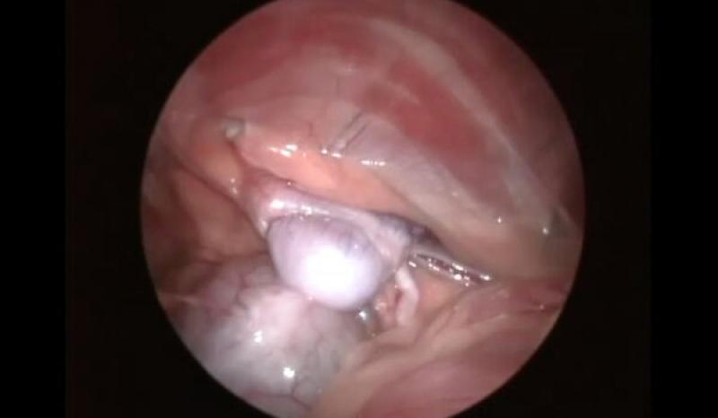 Figura 1. (A) Imagen laparoscópica de la localización del testículo abdominal derecho estando junto al borde lateral de la vejiga de la orina en el que se identifica el epidídimo, la arteria y vena testicular, el conducto deferente, el ligamento de la cola de epidídimio y el estroma testicular.