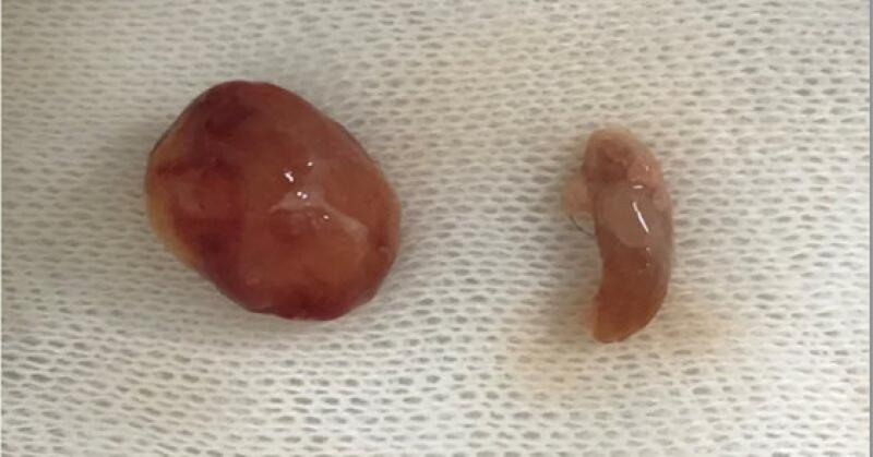 Figura 1. A la izquierda se observan lóbulos tiroideos normales. A la derecha observamos glándula tiroidea izquierda con neoplasia.
