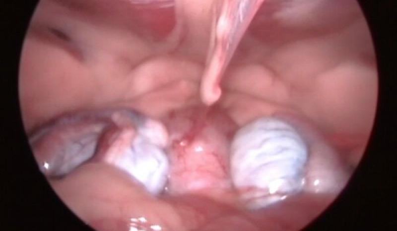 Figura 1. (B) Imagen laparoscópica de criptórquido abdominal bilateral.