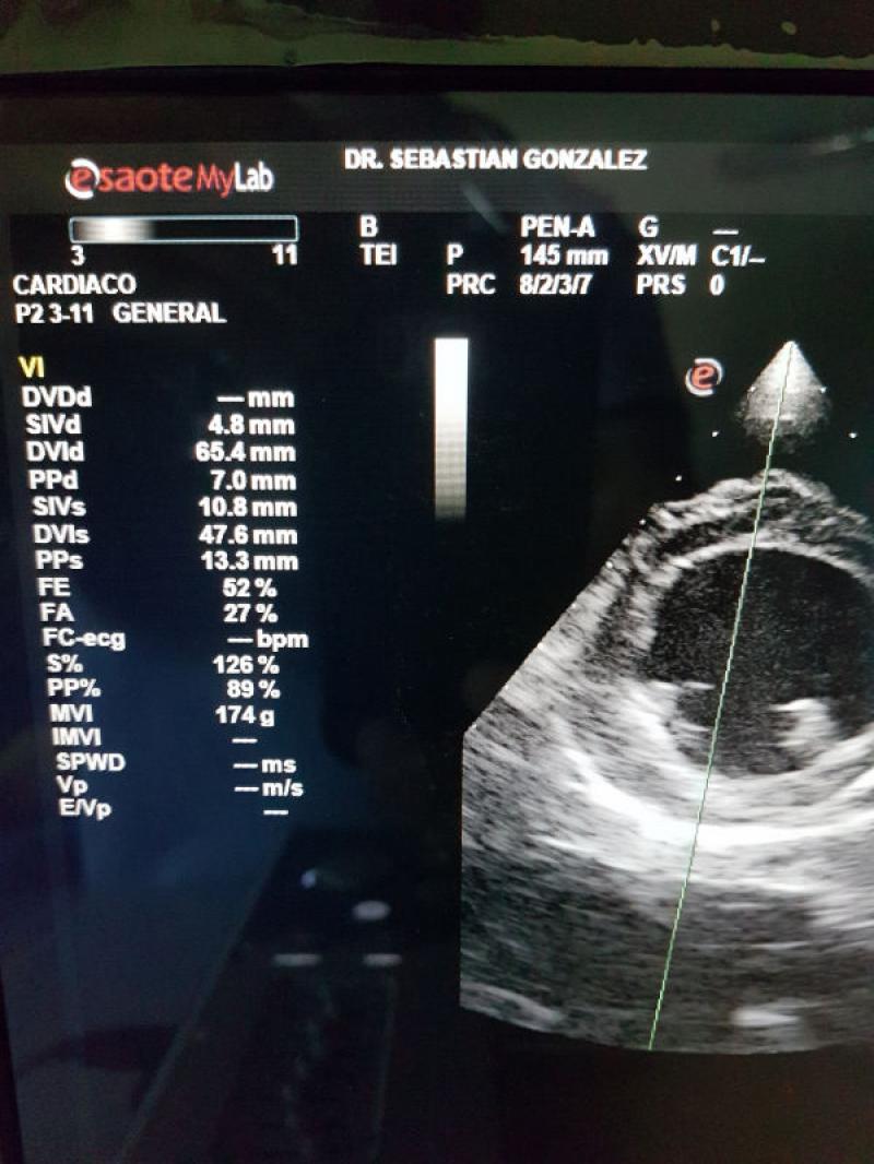 Figura 1. Cardiotoxicidad grado II con presentación de miocardiopatía dilatada.