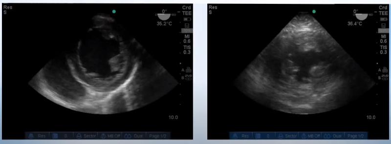 Figura 1. Comparación de un corazón en corte transversal normovolémico (izquierda) y uno hipovolémico (derecha).