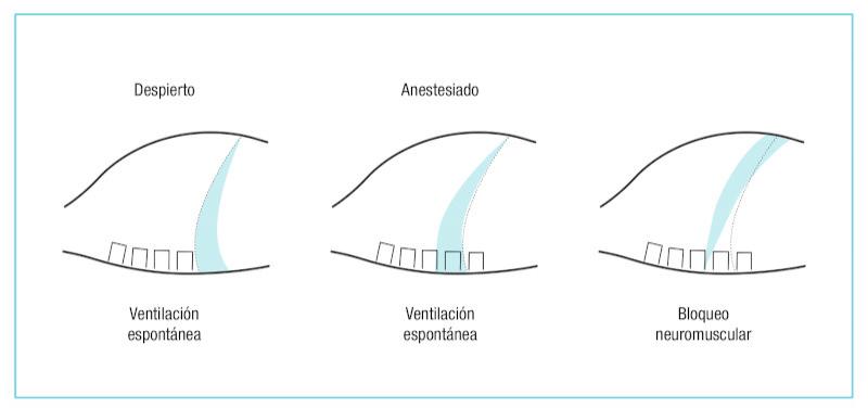 Figura 1. Desplazamientos diafragmáticos debido a la anestesia general y el bloqueo neuromuscular.