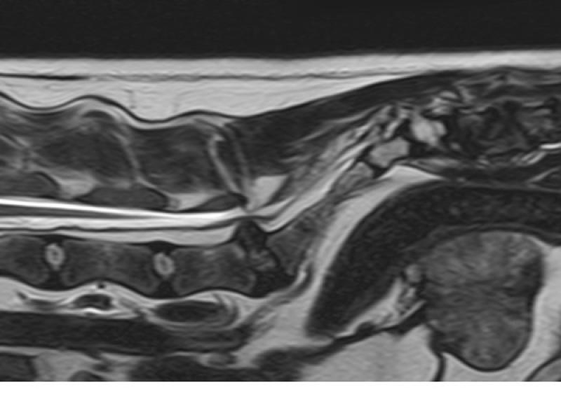 Figura 1. Imagen sagital potenciada en T2 de resonancia magnética de un paciente con estenosis lumbosacra mostrando disco IV mineralizado y protruido produciendo estenosis moderada del canal vertebral, así como desplazamiento y compresión de la cauda equina.