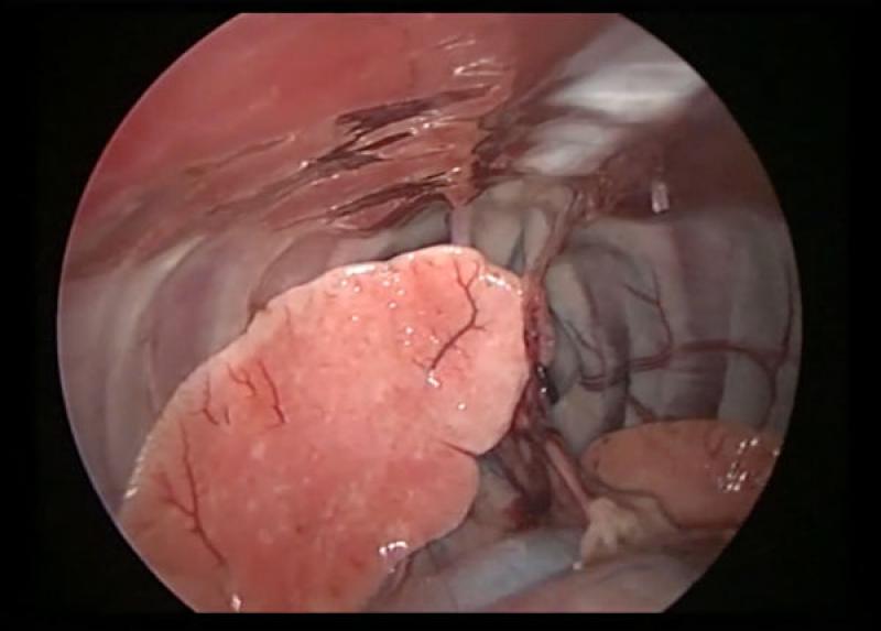 Figura 1. Imagen toracoscópica: nótese cómo con la ventilación unipulmonar, mediante bloqueo bronquial permite una mejora del campo quirúrgico.