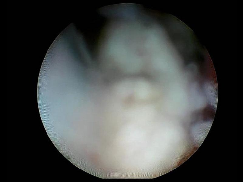 Figura 1: Rinoscopia meato derecho, se puede visualizar de cerca el aspecto de la masa, recubierta por secreción mucosa.