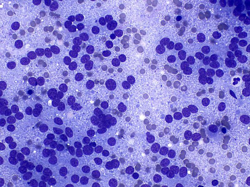 Figura 10 A. Hallazgos citológicos en feocromocitoma. (A) Muestra un número elevado de núcleos desnudos sobre un fondo azulado formado por el citoplasma de las células rotas. (B, C, D) Véanse células intactas con morfología redondeada a poligonal y bordes bien definidos. Tinción de tipo Romanowsky, objetivos de 40x (A, B, C) y 100x (D).