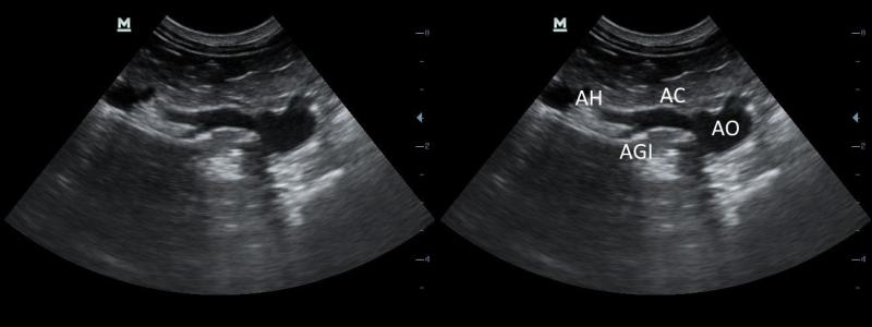 Figura 10: Arteria aorta abdominal (AO), Arteria celiaca (AC), arteria hepática (AH) y arteria gástrica izquierda (AGI).