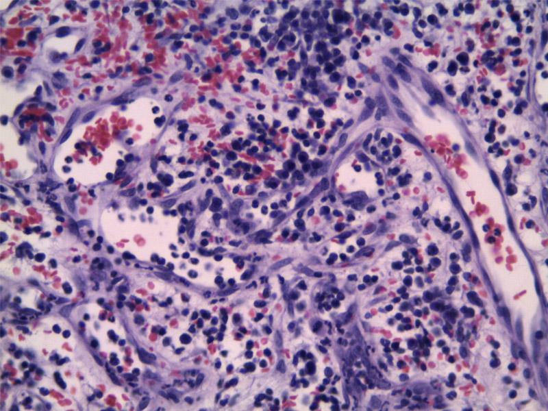 Figura 10. Biopsia cortesía de David Sardón Servicio de anatomía patológica del HCV UAX. HSA tipo Capilar: Espacios vasculares formados por capas únicas y múltiples de células neoplásicas soportadas por trabéculas de colágeno y fibras de colágeno.