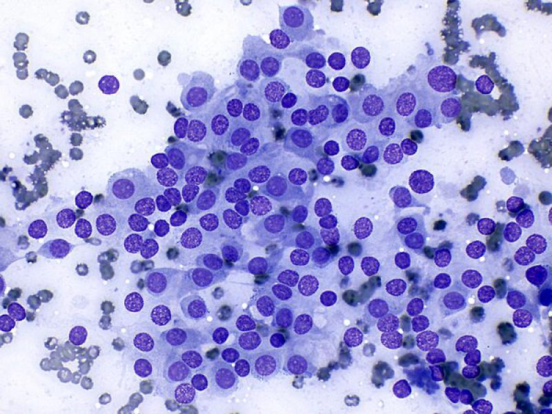 Figura 10 C. Hallazgos citológicos en feocromocitoma. (A) Muestra un número elevado de núcleos desnudos sobre un fondo azulado formado por el citoplasma de las células rotas. (B, C, D) Véanse células intactas con morfología redondeada a poligonal y bordes bien definidos. Tinción de tipo Romanowsky, objetivos de 40x (A, B, C) y 100x (D).