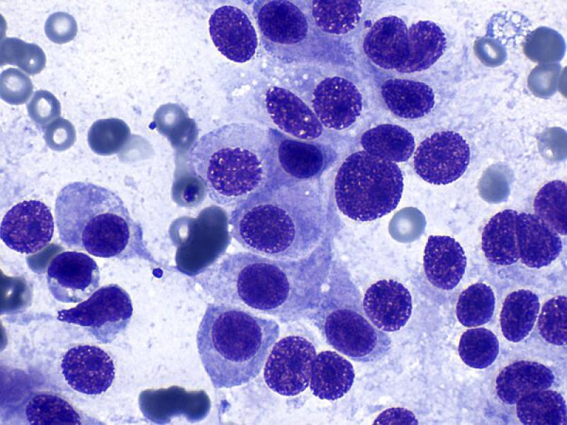 Figura 10 D. Hallazgos citológicos en feocromocitoma. (A) Muestra un número elevado de núcleos desnudos sobre un fondo azulado formado por el citoplasma de las células rotas. (B, C, D) Véanse células intactas con morfología redondeada a poligonal y bordes bien definidos. Tinción de tipo Romanowsky, objetivos de 40x (A, B, C) y 100x (D).