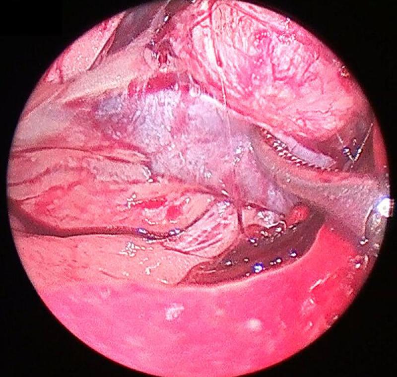 Figura 10. Detalle del plano de disección entre la vena cava (abajo) y la glándula adrenal (derecha).