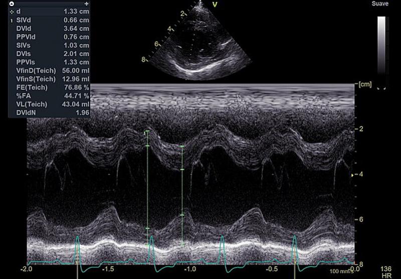 Figura 10. Ecoardiografía Modo M: incremento del diámetro del ventrículo izquierdo en diástole normalizado al peso (DVIDN): 1,96