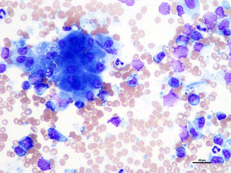 Figura 10A. Neoplasias de células redondas que pueden encontrarse en hígado: Linfoma.