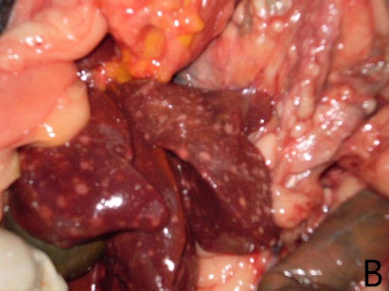 Figura 10B. (B) Imagen del hígado afectado con el mismo tipo de infiltrado granulomatoso de A.