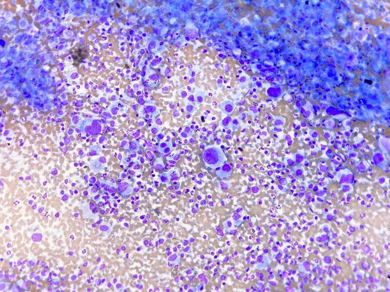 Figura 10B. Neoplasias de células redondas que pueden encontrarse en hígado: Sarcoma.