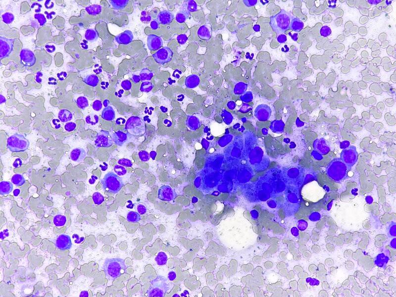 Figura 10C. Neoplasias de células redondas que pueden encontrarse en hígado: Histiocítico.