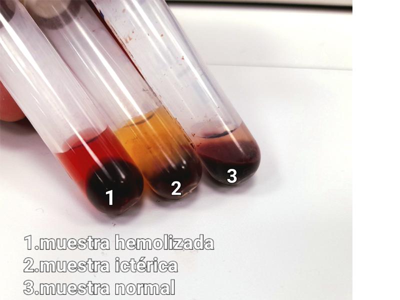 Figura 11. Diferentes muestras sanguíneas (hemolisis, ictericia?)