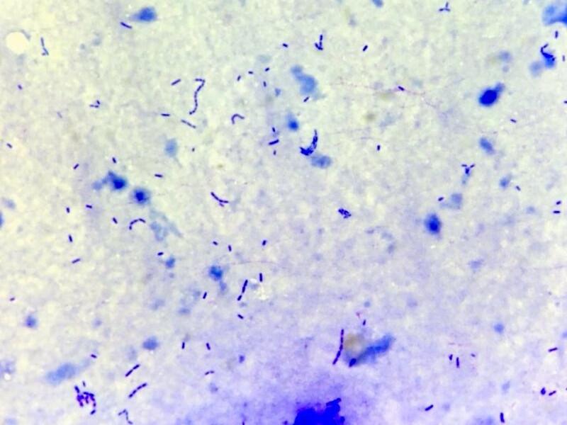Figura 11A. Presencia de bacterias en bilis (bactibilia).