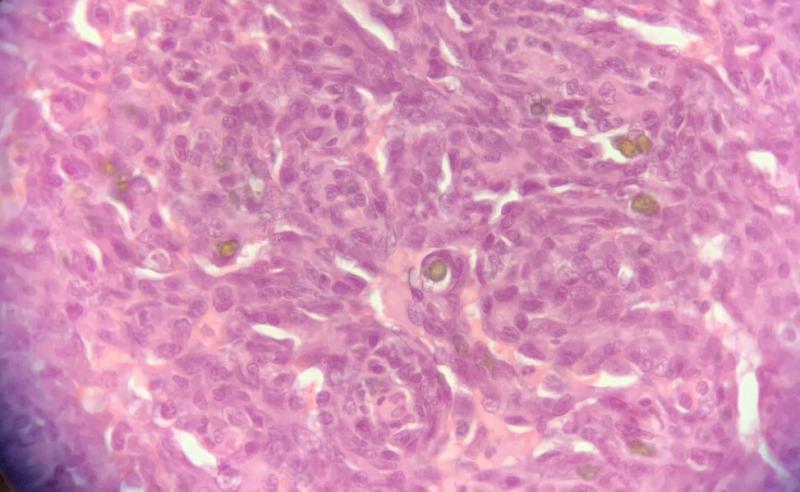 Figura 12. Biopsia cortesía de David Sardón Servicio de anatomía patológica del HCV UAX. HSA tipo sólido: Cordones sólidos formados por células fusiformes en proliferación que rodean pequeños canales vasculares, también se observa la presencia hemosiderina.