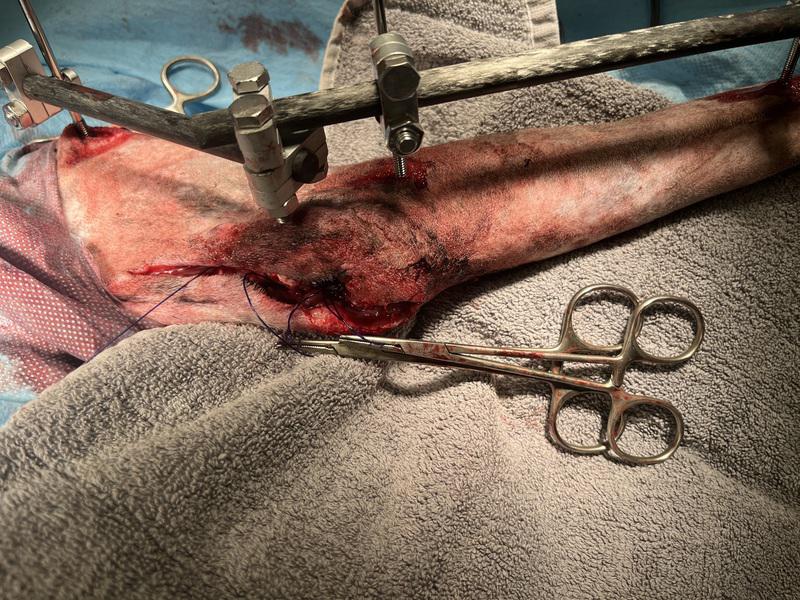 Figura 12. imagen intraoperatoria. Una vez colocado el fijador transarticular, se procedió a anudar las suturas y finalizar la tenorrafia.