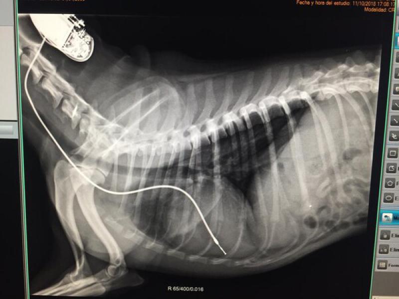 Figura 12: Momento de insuflado del balón controlado por fluoroscopia.      Figura 14: Radiografía postquirúrgica del paciente con el marcapasos ya implantado.