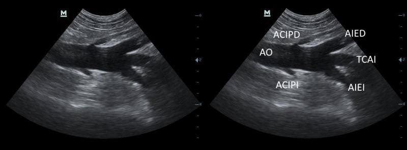 Figura 13: Arteria aorta abdominal (AO). Arteria circunfleja iliaca profunda derecha (ACIPD) e izquierda (ACIPI), arteria ilíaca externa izquierda (AIEI) y derecha (AIED) y tronco común de las arterias iliacas internas (TCAI).