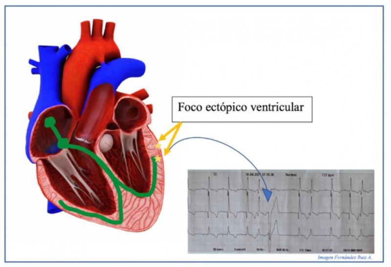 Figura 13. Foco ectópico ventricular y formación del CPV.