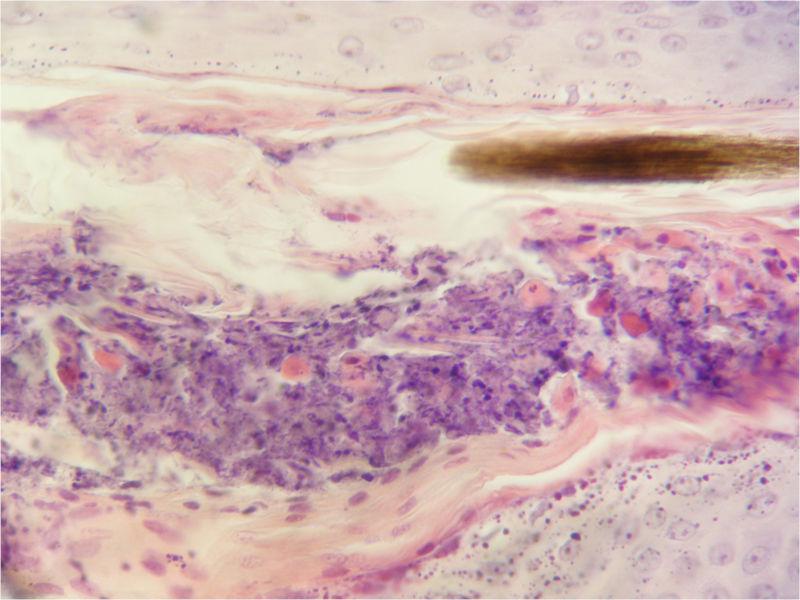 Figura 13. Imagen histopatológica del paciente de la figura anterior donde se observa una foliculitis luminal neutrofílica con numerosos queratinocitos acantolíticos. Imagen cortesía de Annabel Dalmau.