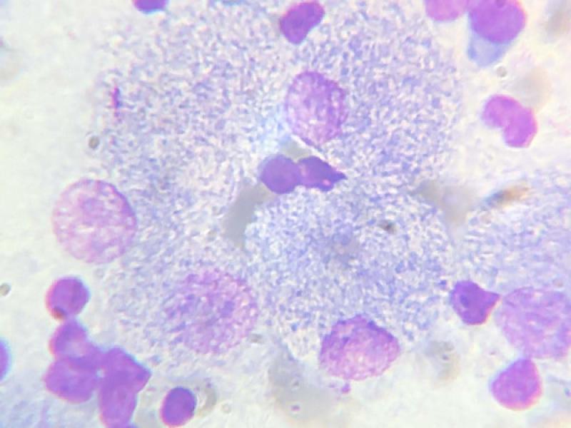 Figura 13. Población linfoide heterogénea con predominio de linfocitos pequeños. Presencia de abundantes macrófagos y células gigantes multinucleadas con gran cantidad de bacilos intracitoplasmáticos con tinción negativa compatibles con micobacterias (Tinción de Giemsa).
