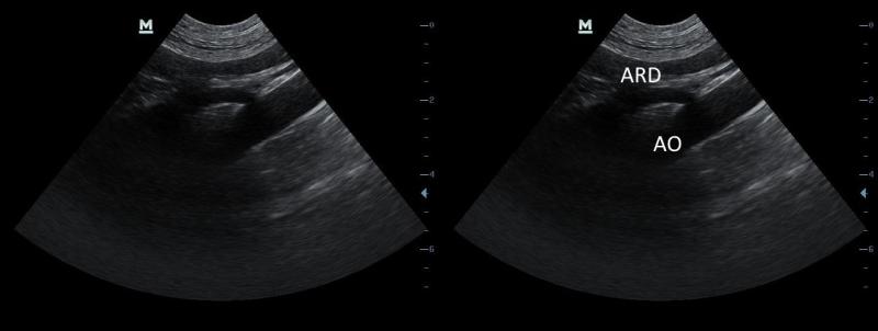 Figura 14: Arteria renal derecha (ARD)
