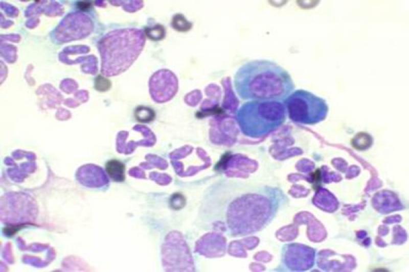 Figura 14. Conjuntivitis con respuesta de células plasmáticas.