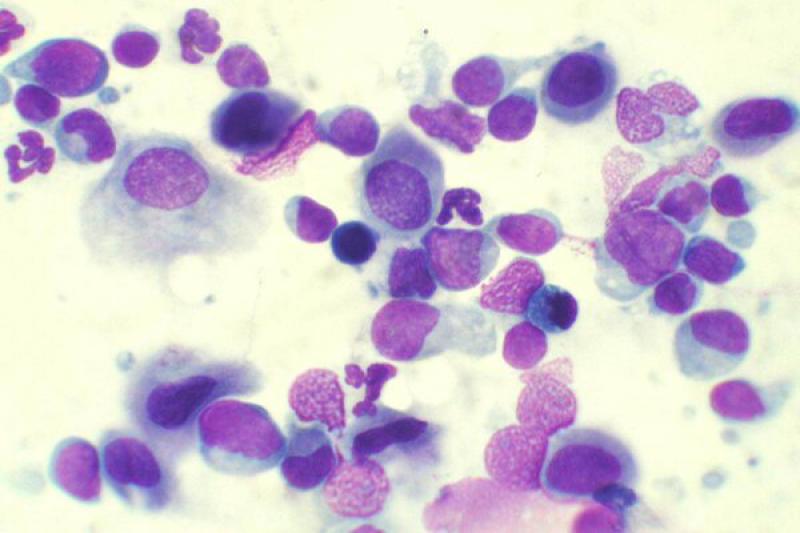 Figura 15. Conjuntivitis folicular con una población numerosa de linfocitos de distintos tamaños.