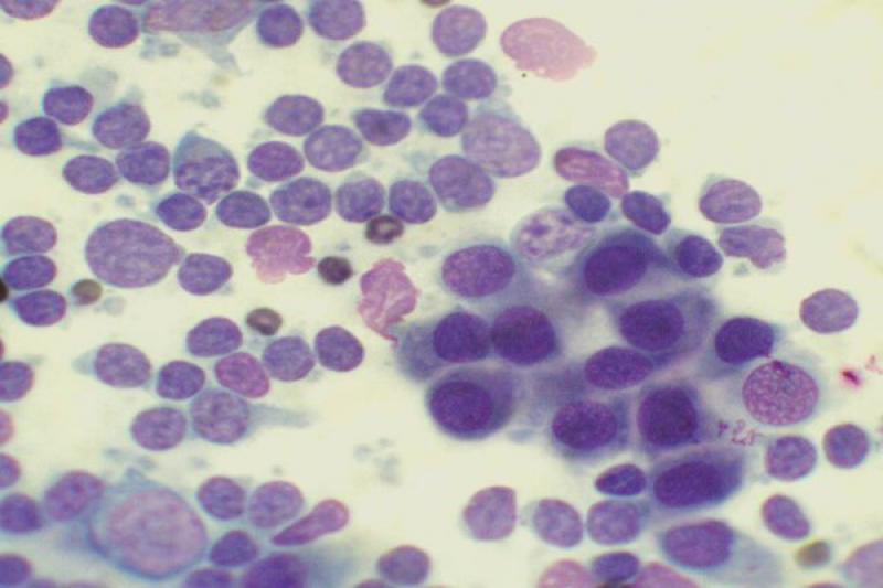 Figura 16. Conjuntivitis folicular con una población numerosa de linfocitos de distintos tamaños.