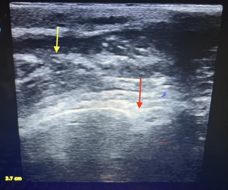 Figura 17. ecografía musculoesquelética de seguimiento a las 8 semanas. La flecha roja indica la localización del olécranon. La flecha amarilla indica la continuidad en el tendón del tríceps.
