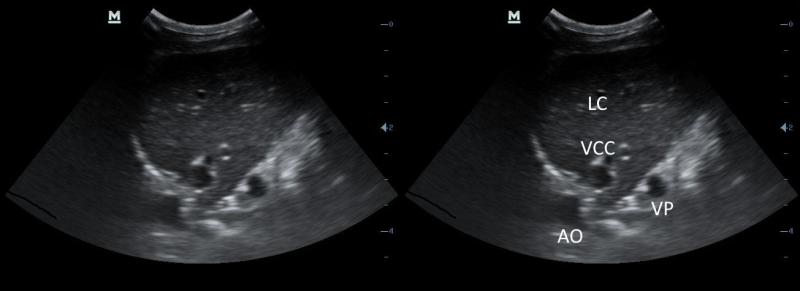 Figura 17: Vena cava caudal (VCC), arteria aorta (AO) y vena porta (VP) en corte transversal. Lóbulo caudado del hígado (LC).
