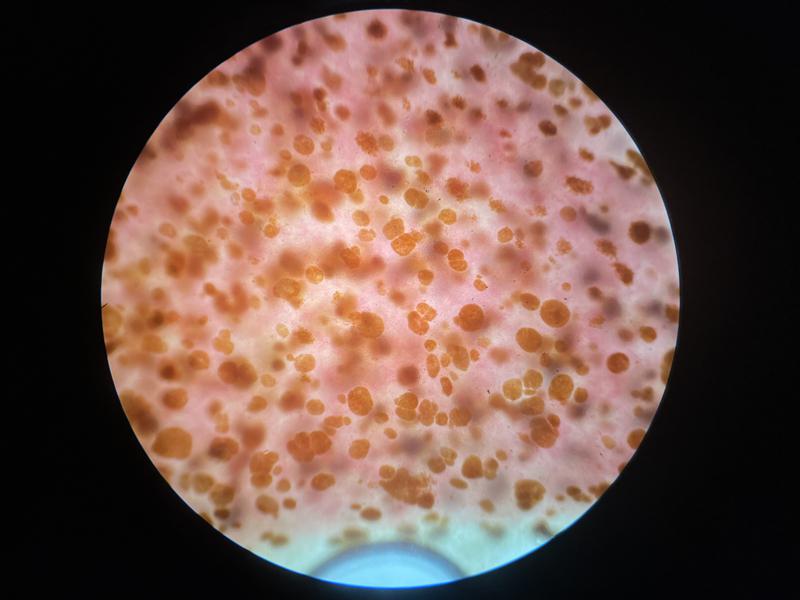 Figura 18a. Muestra de hígado de Symphodus sp con aumento de centros de melanomacrófagos 100x