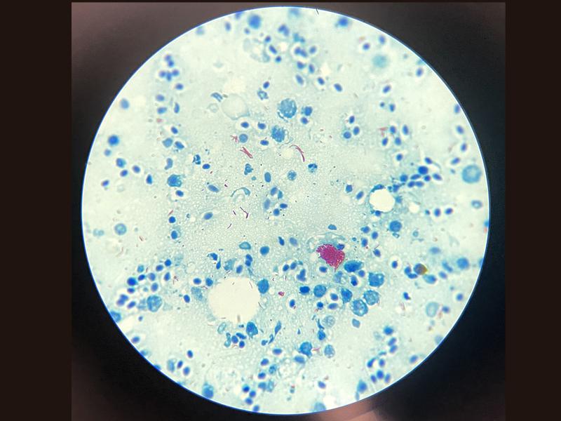Figura 19. Impronta de riñón de Thayeria boehlkei con lesiones granulomatosas, tinción Ziehl-Neelsen que evidencia la presencia de bacterias acido-alcohol resistentes de color magenta. 1000x